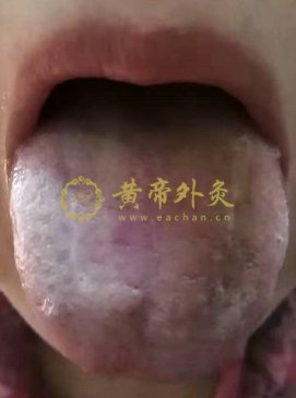 女性复发性尿道感染太阳并少阳证传入太阴厥阴